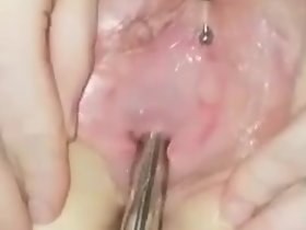 الإحليل السبر اختراق مزدوج